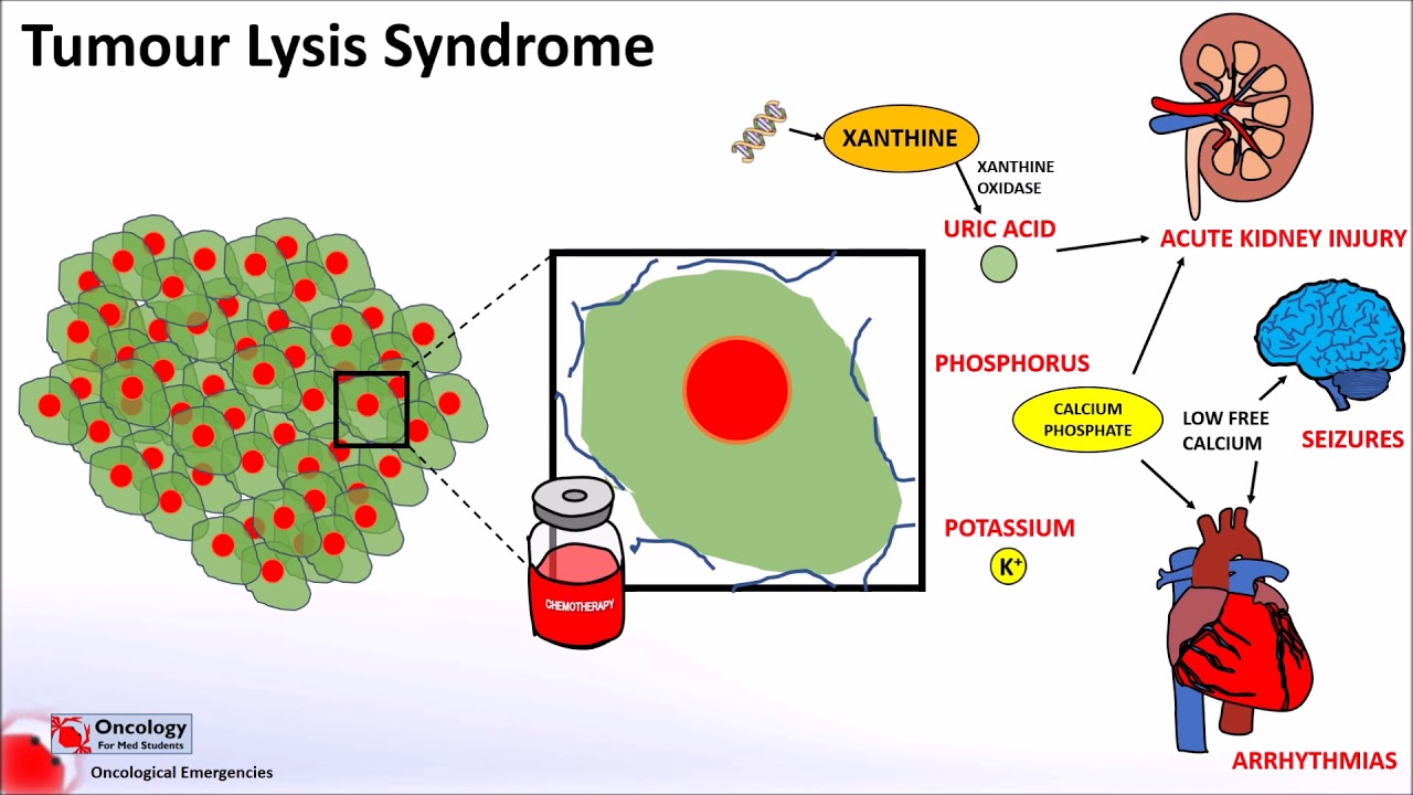 tumor lysis syndrome