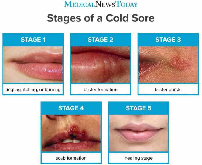 cold-sores-nhs