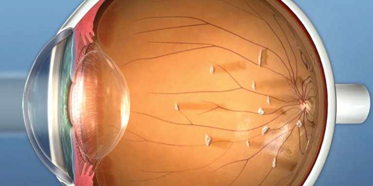 Floaters In The Eye Treatment Symptoms And Causes – APK Beasts Platform