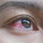 popped blood vessel in eye