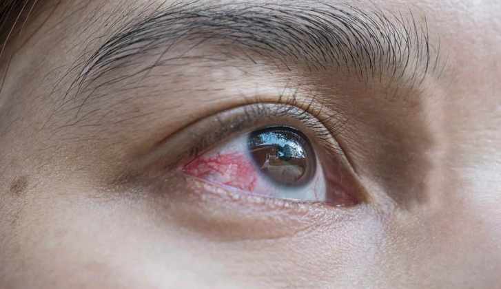 popped-blood-vessel-in-eye-can-warn-of-strokes